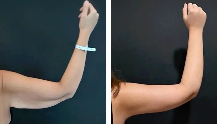 before & after photo of Arm Lift