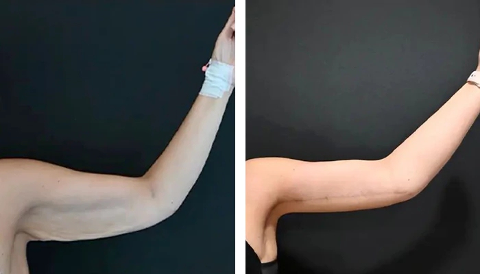 before & after photo of arm-lift