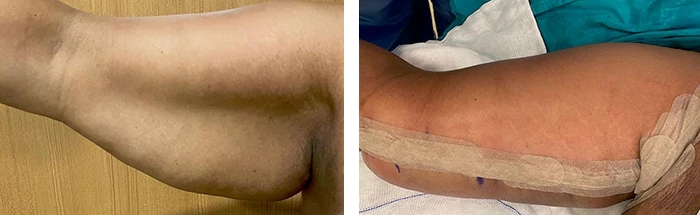 before & after photo of Liposuction