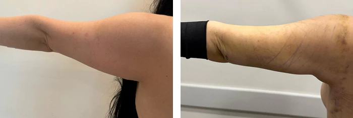 before & after photo of Arm Lift