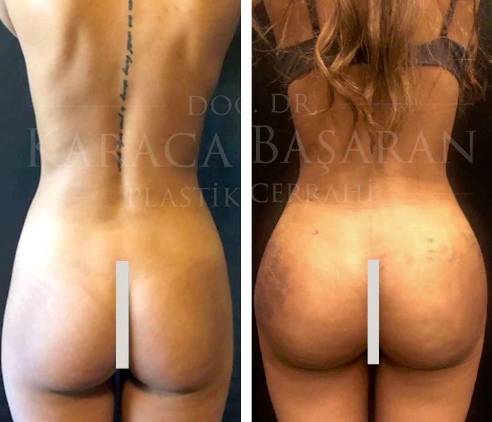 before & after photo of Tummy Tuck