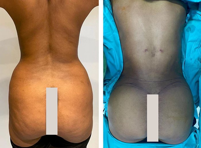 before & after photo of Liposuction