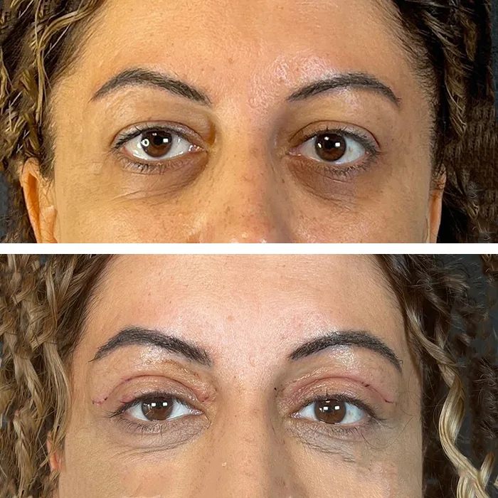 before & after photo of عملية تجميل الجفون