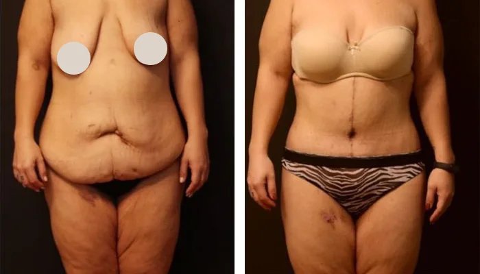 before & after photo of Body Lift