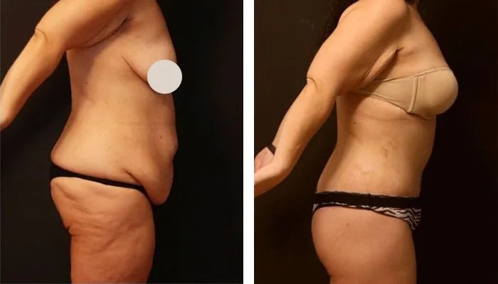 before & after photo of Body Lift