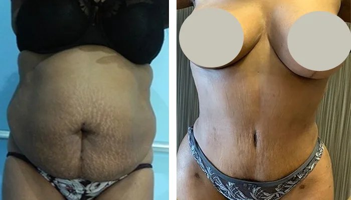 before & after photo of Body Lift