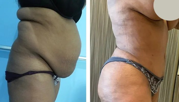 before & after photo of Body Lift