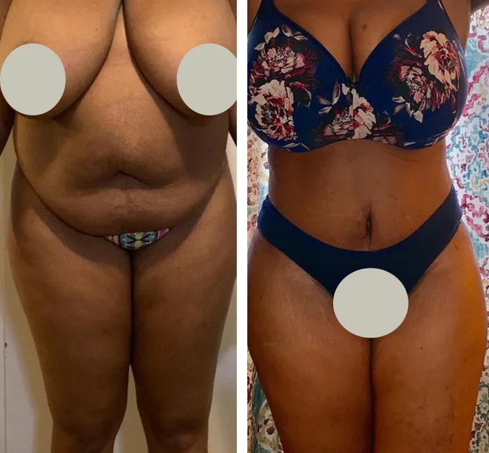 before & after photo of Body Lift