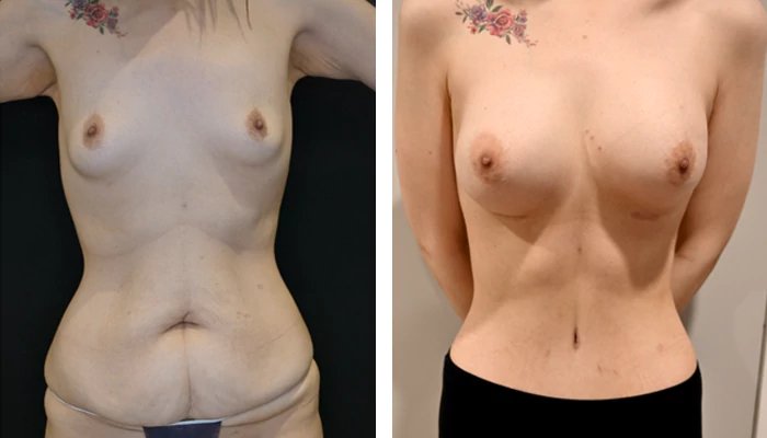 before & after photo of Body Lift