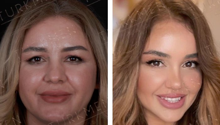 before & after photo of botox-injection