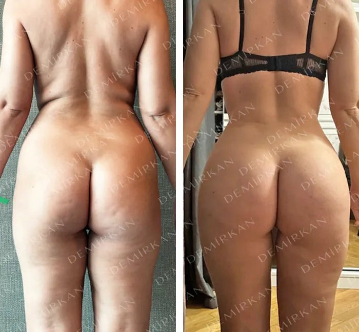 before & after photo of تصغير الحلمة/ الهالة