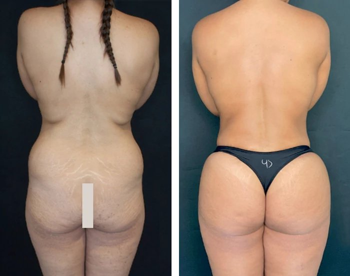 before & after photo of Tummy Tuck