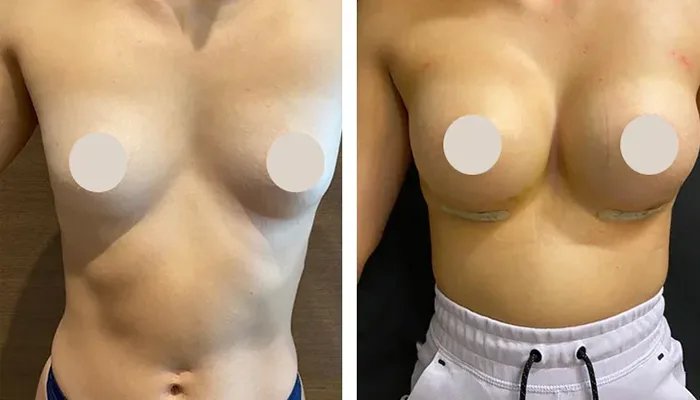 before & after photo of Breast Augmentation