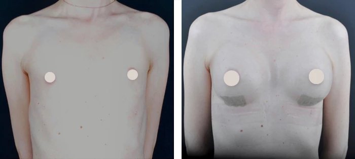 before & after photo of Breast Reduction