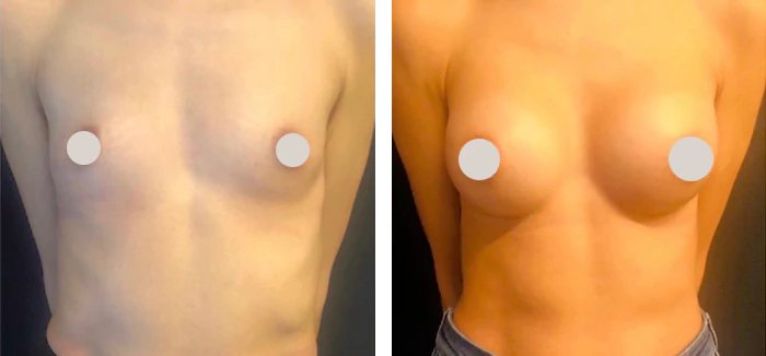 before & after photo of Breast Reduction