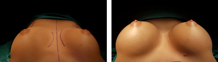 before & after photo of Breast Lift