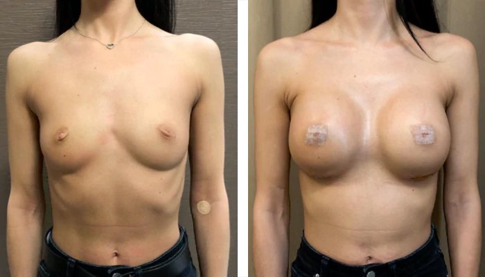 before & after photo of Breast Lift