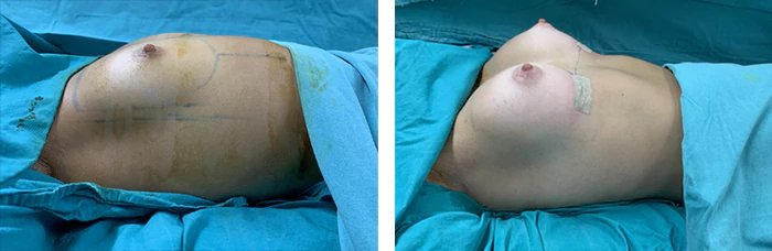 before & after photo of Tummy Tuck