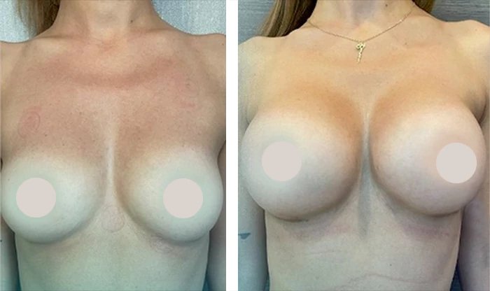 before & after photo of Breast Lift