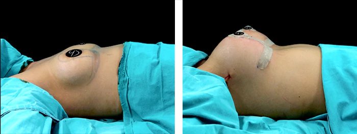 before & after photo of Tummy Tuck