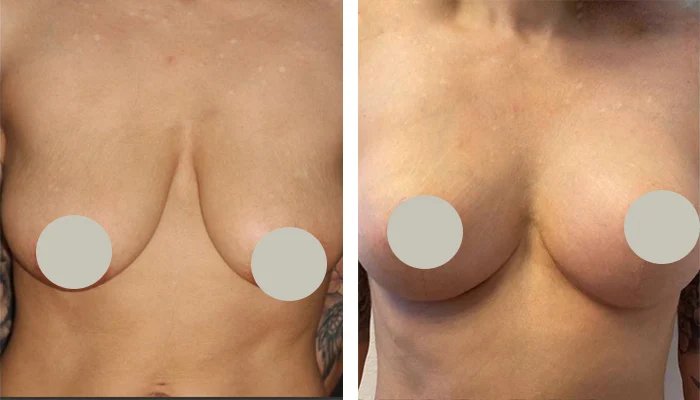 before & after photo of Breast Lift