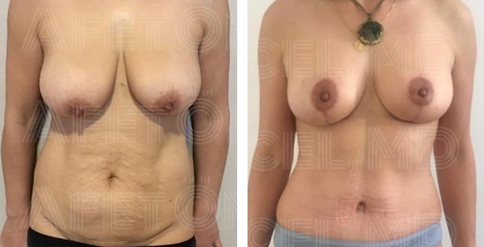 before & after photo of عملية تجميل الأنف