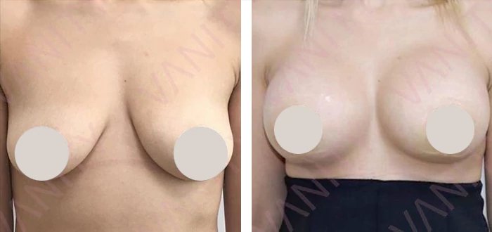 before & after photo of Tummy Tuck