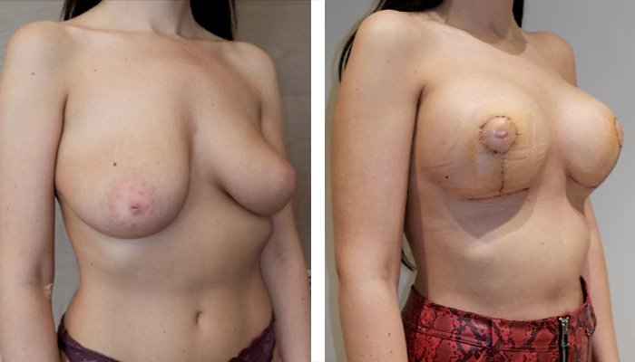 before & after photo of Breast Lift