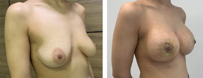 before & after photo of عملية تجميل الأنف