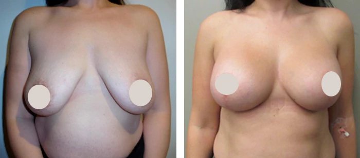 before & after photo of Liposuction