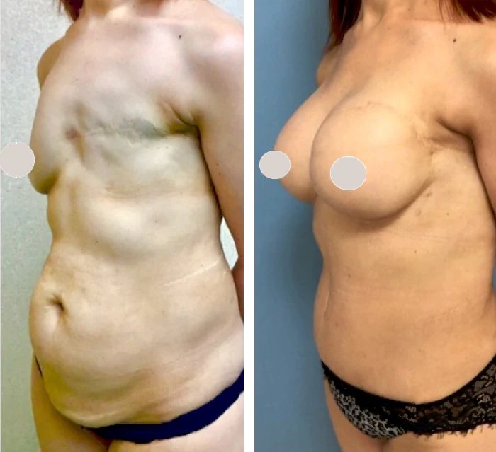 before & after photo of Breast Reconstruction Surgery