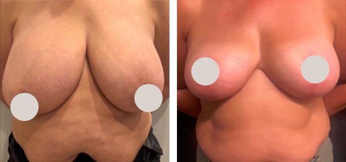 before & after photo of Breast Reduction