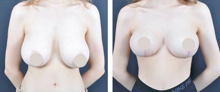 before & after photo of Breast Reduction