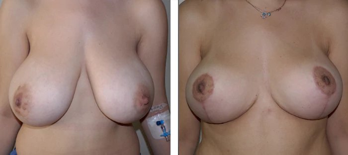 before & after photo of breast-reduction