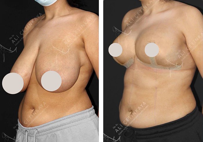 before & after photo of breast-reduction