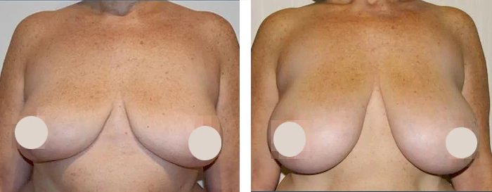 before & after photo of Breast Reduction