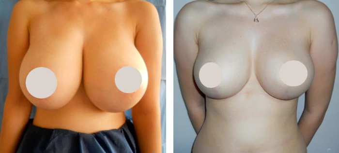 before & after photo of Liposuction