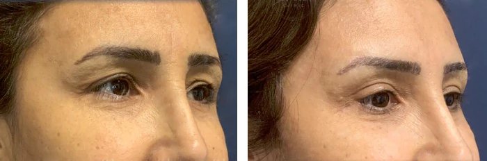 before & after photo of brow-lift