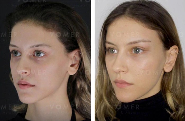 before & after photo of brow-lift
