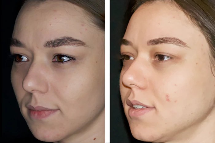before & after photo of Buccal Fat Removal
