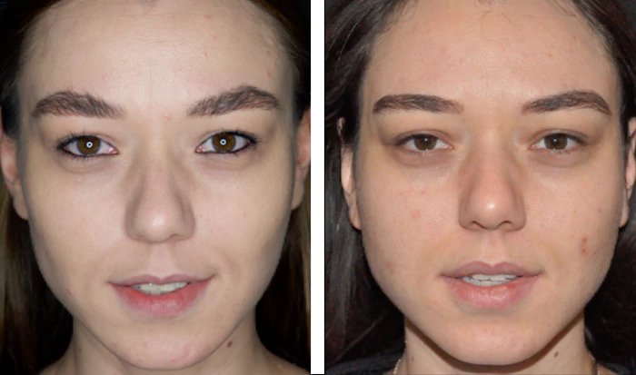 before & after photo of Buccal Fat Removal