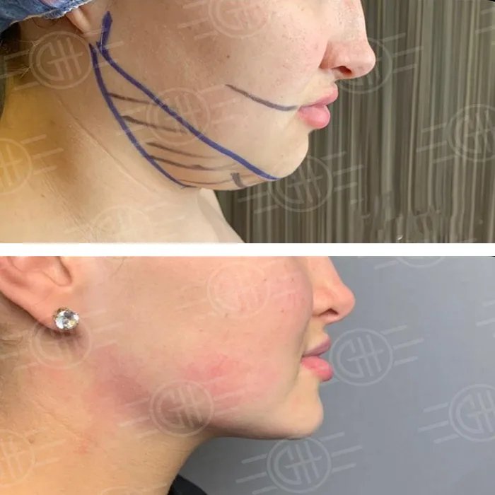 before & after photo of Double Chin Removal