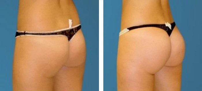 before & after photo of butt-implants