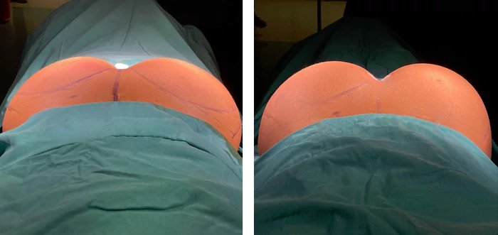 before & after photo of butt-lift