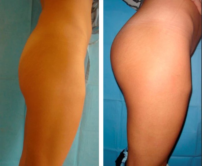 before & after photo of Liposuction