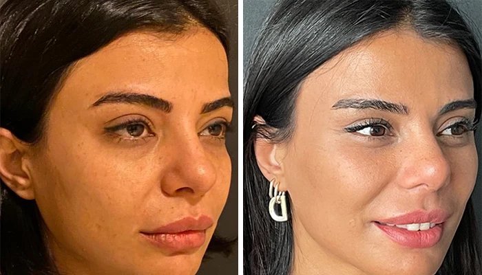 before & after photo of عملية تجميل الجفون