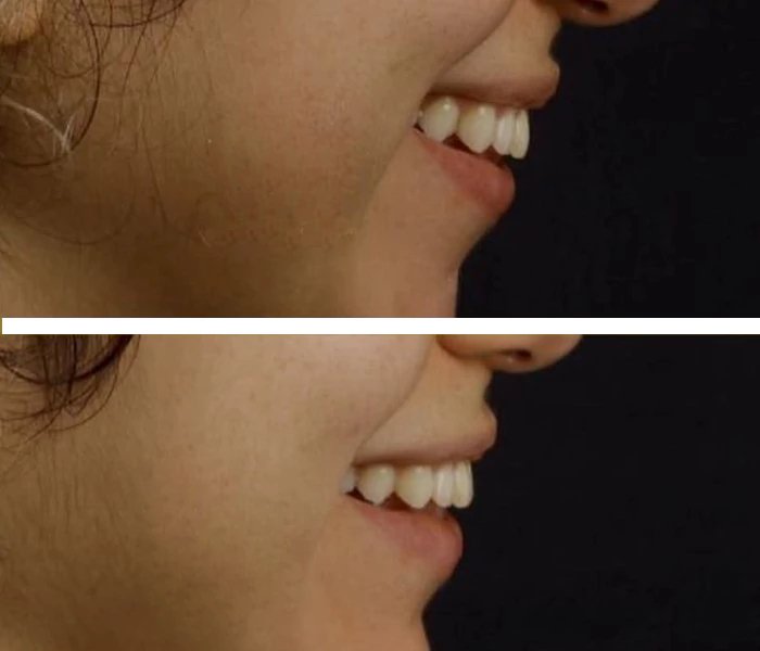 before & after photo of Chin and Jawline Filler