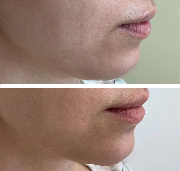 before & after photo of Chin and Jawline Filler