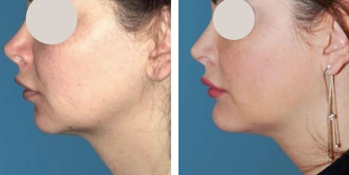 before & after photo of chin-implants