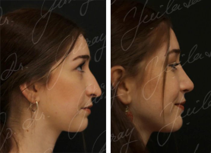 before & after photo of Chin Implants